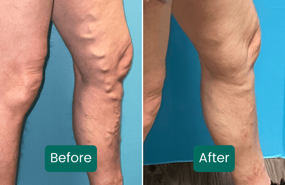 Varicose veins
